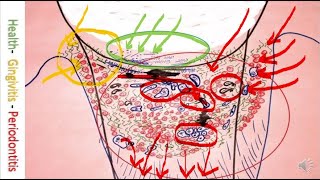 Periodontitis Cure by Bonner Method microscope caricature and drawing Gum disease [upl. by Selena]