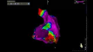 HEART ABLATION ΕΡΡΙΚΟΣ ΝΤΥΝΑΝ [upl. by Ytok]