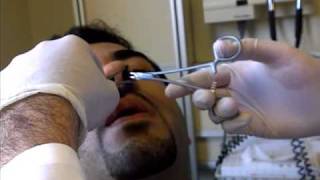 Nose Splint Removal in ED [upl. by Ogawa]