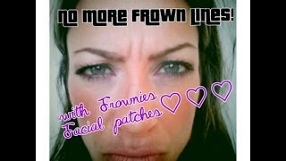 Get rid of wrinkles amp quotthe 11squot  frown lines with FROWNIES  NO BOTOX facetape [upl. by Itnaihc451]