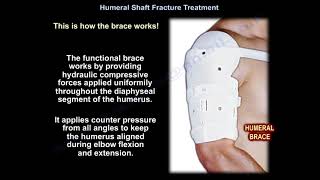 Humeral Shaft Fracture Treatment  Everything You Need To Know  Dr Nabil Ebraheim [upl. by Einnaffit]