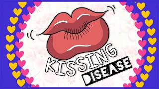 Infectious mononucleosis Kissing disease Diagnosis Clinical feature Treatment [upl. by Holt932]