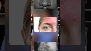 Acne Rosacea Explained acne rosacea [upl. by Llehsyt]