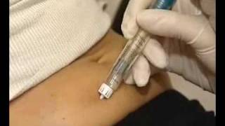 How correctly use multidose GONAL  F injection [upl. by Qifahs]