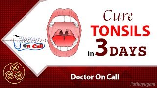 Quick Home Remedies for Tonsillitis in 3 Days  Doctor On Call [upl. by Franni]