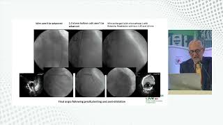 Calcium Debulking Strategy using Rotational Atherectomy by Dr Imad Sheiban [upl. by Nicholas367]