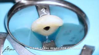 Root canal treatment on the maxillary central incisor tooth 21 [upl. by Bibbie]