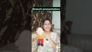 Breech presentation normal delivery or caesareanmedicalpregnant [upl. by Noryahs]