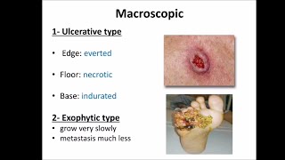 Squamous cell carcinoma SCC [upl. by Wincer36]