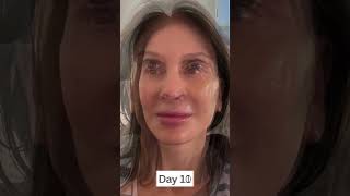 6Week Facelift Healing amp Recovery Progression [upl. by Orland832]