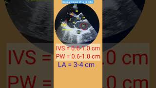 Normal values of IVS LA LV size in Echo l echo shorts [upl. by Albrecht]