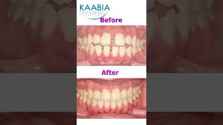 Bimaxillary protrusion  open bite and diastema [upl. by Atir246]