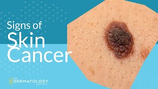 Skin Cancer Screening  Symptoms Types amp Warning Signs [upl. by Aiyt]