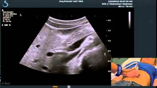 Hot Tips  Locating the Common Bile Duct with Ultrasound [upl. by Oiluarb]