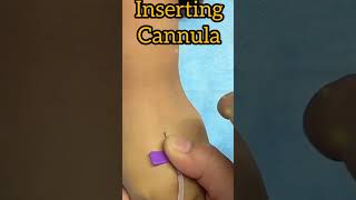 Inserting iv cannula musictrending nursing cannula [upl. by Thury]