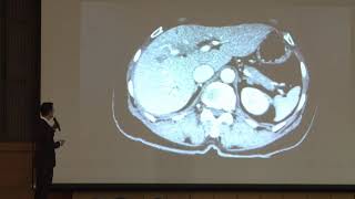 Surgical anatomy of perihilar cholangiocarcinoma [upl. by Lirbij]