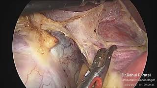 Fibroid Uterus with Dermoid Cyst [upl. by Baryram311]