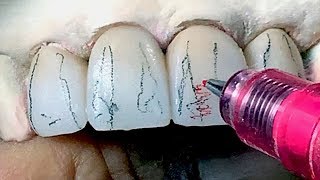 Tooth Morphology Design Techniques for Dental Lab Technicians [upl. by Horan]