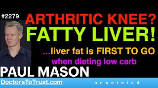 PAUL MASON o1  ARTHRITIC KNEE FATTY LIVER …liver fat is FIRST TO GO when dieting low carb [upl. by Bergeman693]