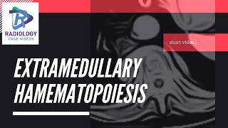 Extramedullary haematopoiesis Umamaheshwar Reddy V [upl. by Rovert560]