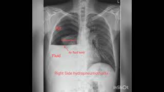 Chest X rays Part 2  Pleural effusion Hydropneumothorax Pneumothorax [upl. by Yelsehc]