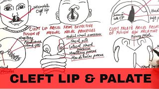 Cleft Lip and Palate  Pathophysiology Causes amp Management [upl. by Huggins]