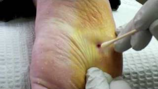 Surgical Plantar Wart Removal [upl. by Akin]