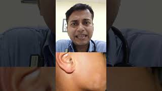 Pityriasis Alba For Consultation please call on 7400124238 shortvideo motivation [upl. by Otrebire915]