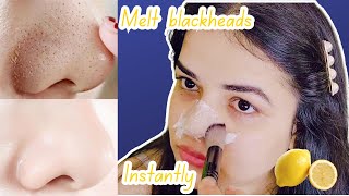 DIY Blackhead Peel Off Mask with an Egg  It Actually WORKS 😲✨ Blackheads Removal on face [upl. by Tades94]