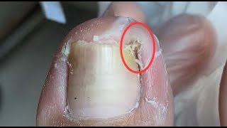 Huge and hard skin under nail and carefully removed it [upl. by Aloeda]