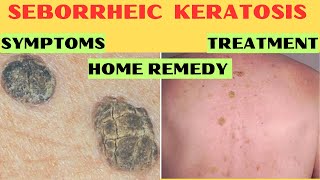 Understanding Seborrheic Keratosis Causes Symptoms Treatment Home Remedies [upl. by Fronia6]