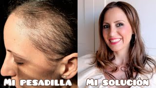 ALOPECIA ANDROGÉNICA SOLUCIÓN A MI PESADILLA [upl. by Herries]