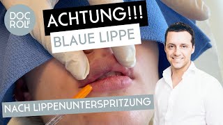 BLAUE LIPPE nach LIPPENUNTERSPRITZUNG Dr Rolf Bartsch [upl. by Aitnahc199]