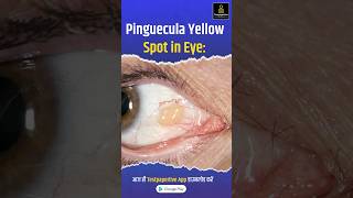 Pinguecula Yellow Spot in Eye Pinguecula eye testpaperlive [upl. by Talley]