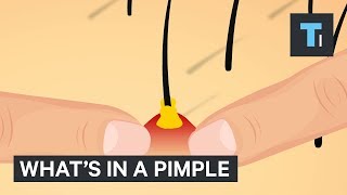 Whats Inside A Pimple [upl. by Nage]