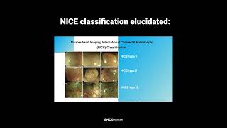 Endoscopic Identifications Key Tips for Differentiating Polyps [upl. by Shayn405]