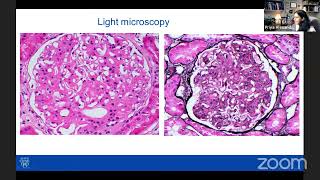 Dr Priya Alexander  Recent advance in the diagnosis of fibrillary glomerulonephritis [upl. by Refinney]