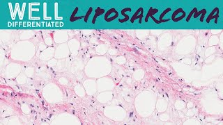 Well differentiated liposarcoma aka atypical lipomatous tumor pathology sarcoma soft tissue tumor [upl. by Bertolde138]