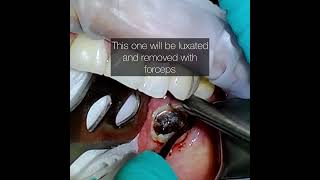 Erupted Decayed Third Molar Extraction Step by Step in an Older Patient [upl. by Hyams]