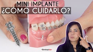 ¿Cómo limpiar los Mini Implantes de ortodoncia 🔩 ¿Qué debo usar  Odontología Láser [upl. by Nilrak]