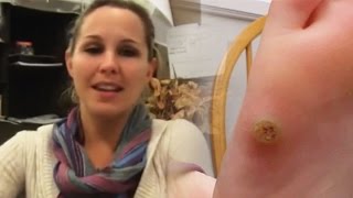 Wart Treatment  Wartrol Reviews  Wart Remover [upl. by Greer]