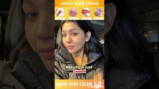 Healing Wounds amp Boosting Skin Health with Abera Cream scarcream damagedskinrepair Abera [upl. by Arbas]