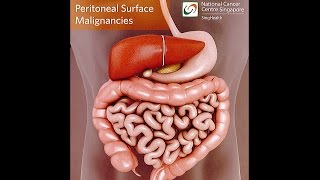 All About Peritoneal Tumours Causes Symptoms Diagnosis and Treatment [upl. by Scammon723]