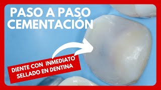 CEMENTACIÓN DE ONLAY DE RESINA COMPUESTA CON SELLADO INMEDIATO EN DENTINA [upl. by Ishmul]