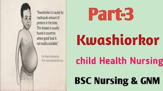 Kwashiorkor20 October 2020 [upl. by Augie]