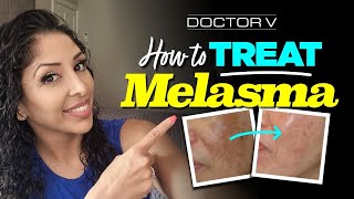 Doctor V  How To Treat Melasma  Skin Of Colour  Brown Or Black Skin [upl. by Babette656]