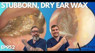 SUPER STUBBORN DRY EAR WAX REMOVAL  EP952 [upl. by Llerral]