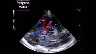 Polígono de Willis doppler cerebral [upl. by Haimehen363]