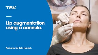 Lip augmentation Cannula technique by Dr Dalvi Humzah [upl. by Zalucki]