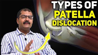 Understanding Types of Patella Dislocation Causes Symptoms and Treatment Options [upl. by Guido]